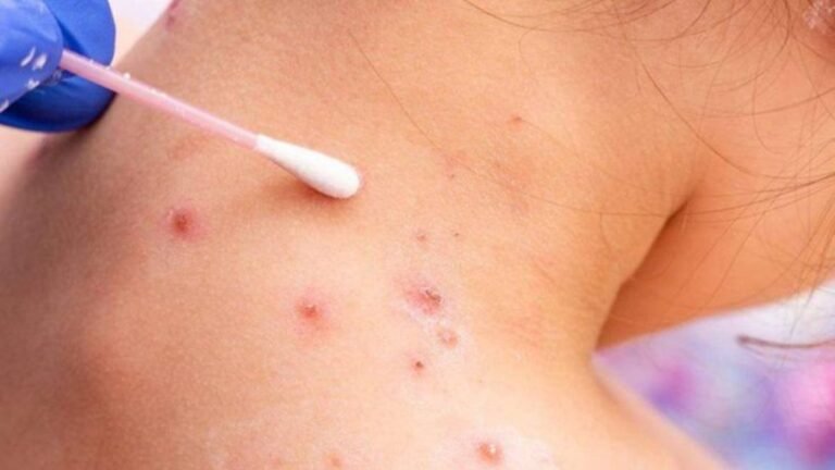 Autoridades aseguran que casos de viruela símica detectados corresponden a una variante de baja agresividad