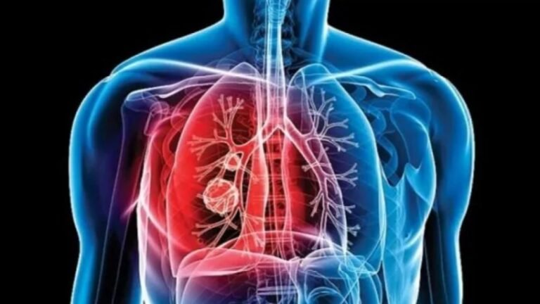 Confirman caso de tuberculosis en centro de detención de inmigrantes en Colorado; autoridades activan protocolo sanitario